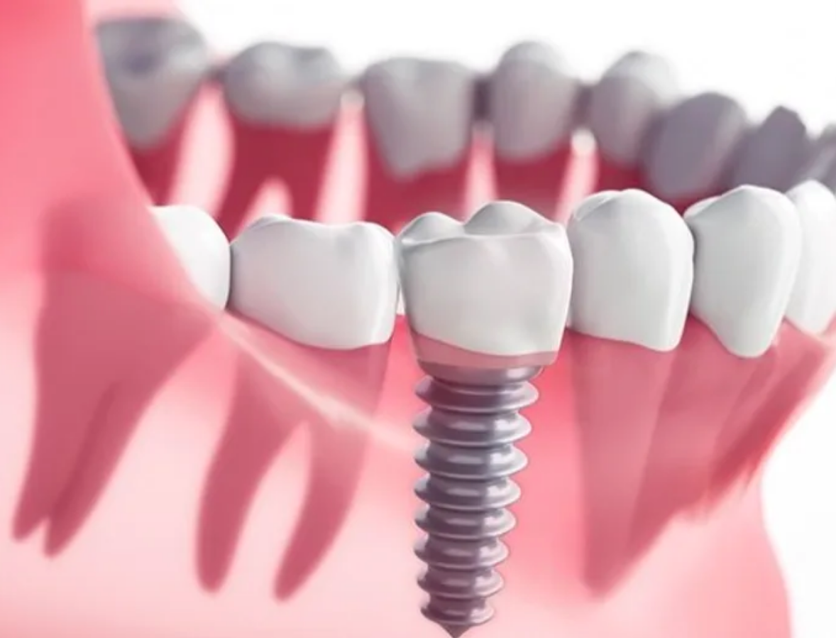 dental implants