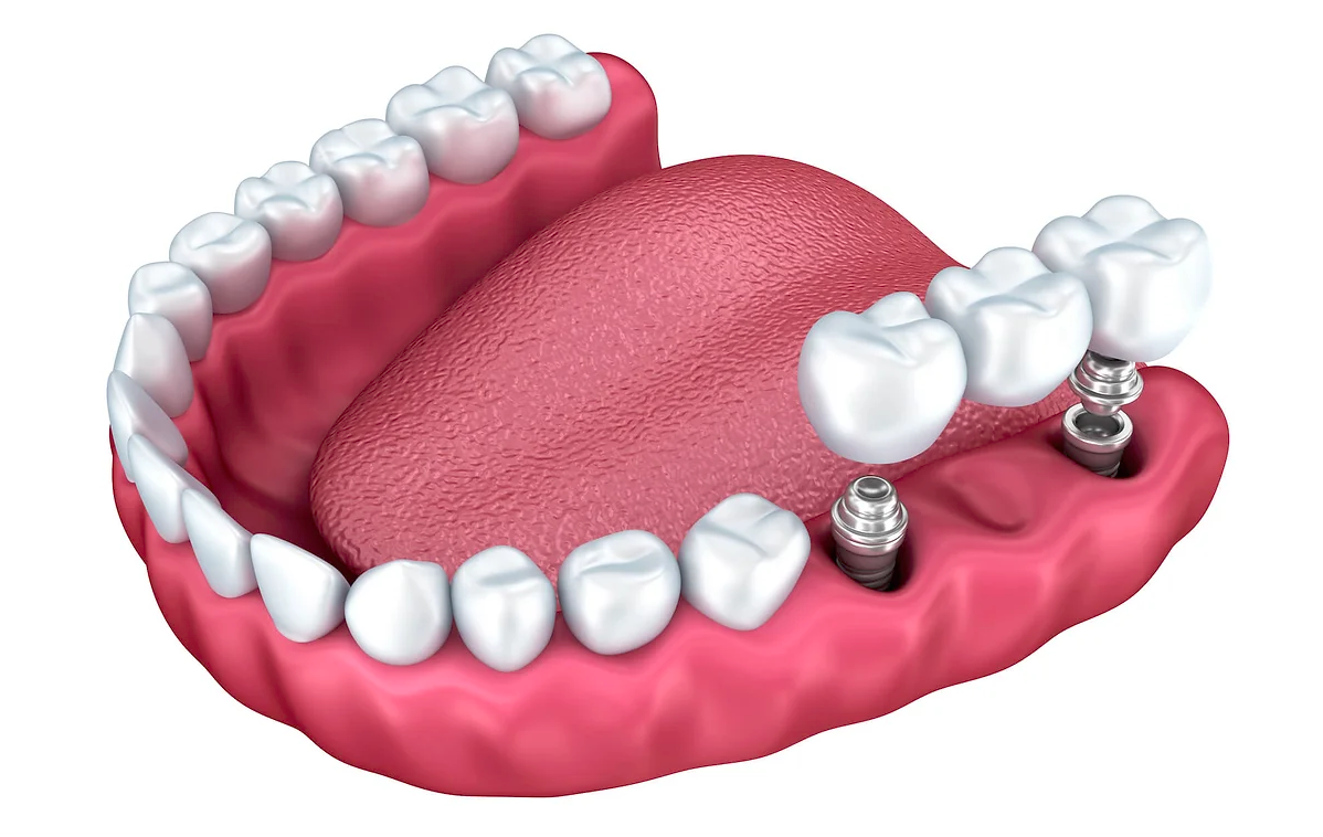 implant supported dentures