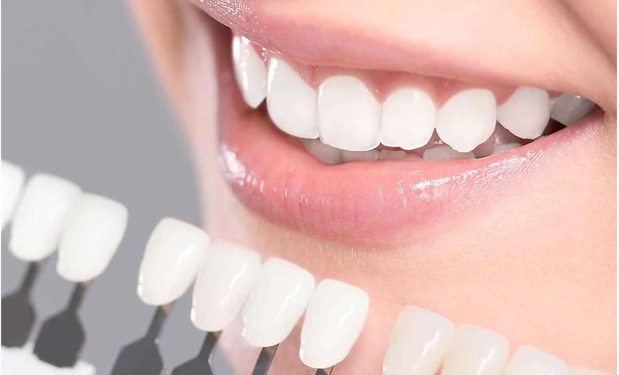 porcelain veneers